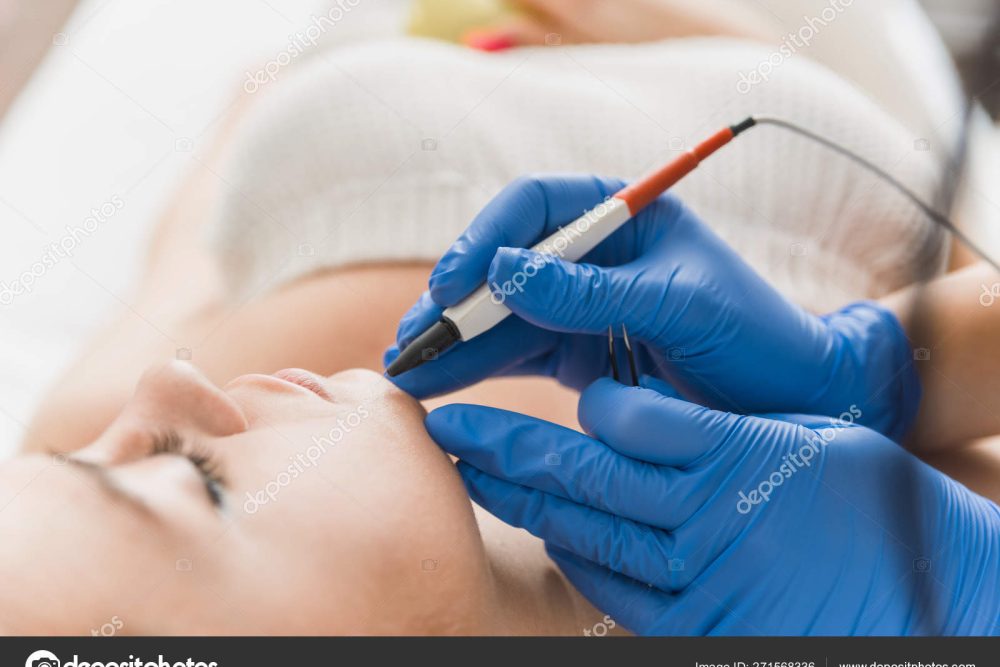 Closeup cropped image of dermatologist's hands doing electro-epilation on patient's chin